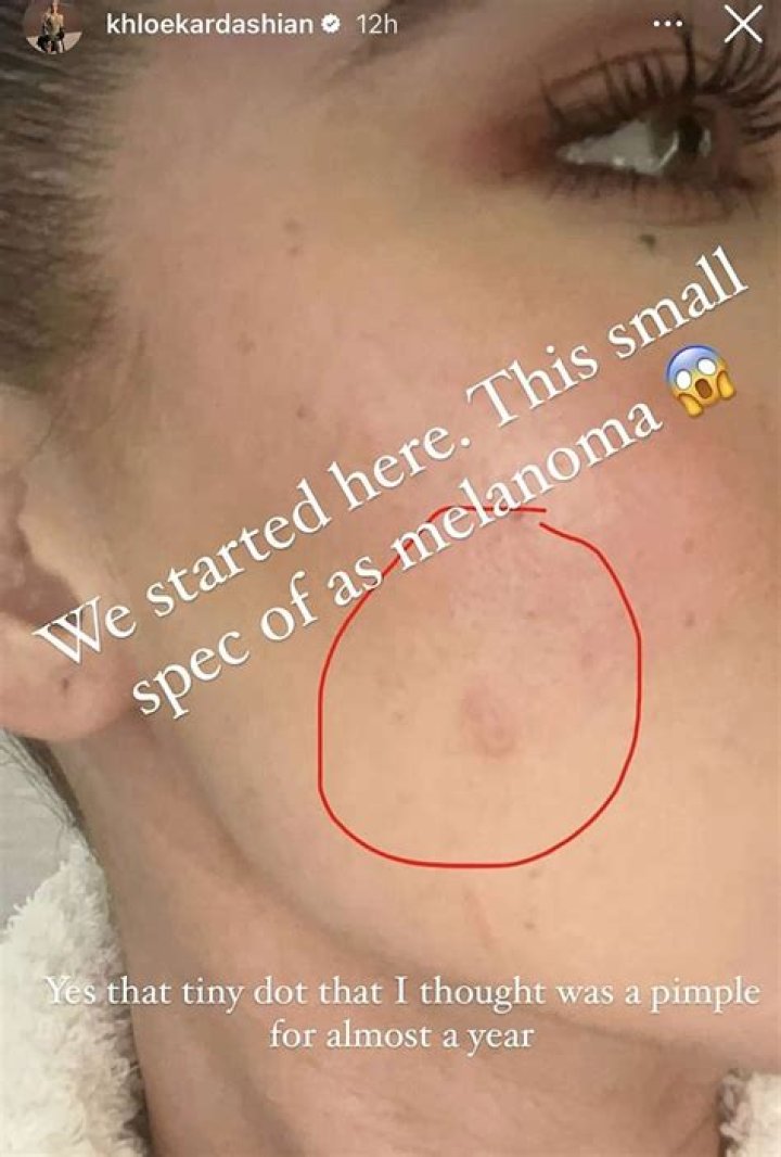 Khloe Kardashian Examines ‘Huge’ Cheek Indentation After Getting Tumor Removed