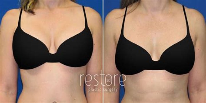 She’s Getting Breast Implants – Hollywood Life