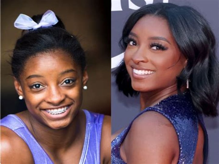 Simone Biles’ Wisdom Teeth Removed — Hilarious Video – Hollywood Life